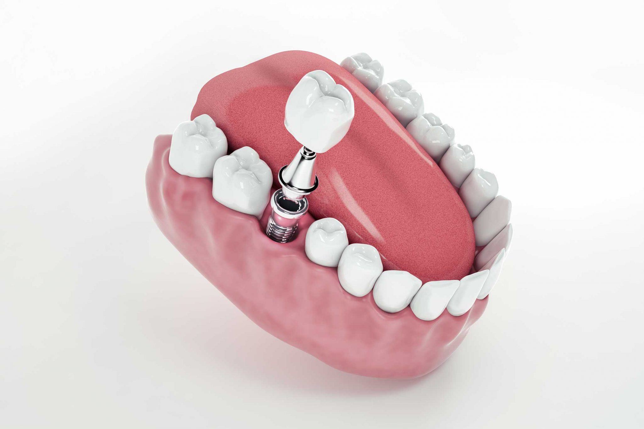 İmplant Nedir? Diş implantı tedavisi kimlere uygulanır?